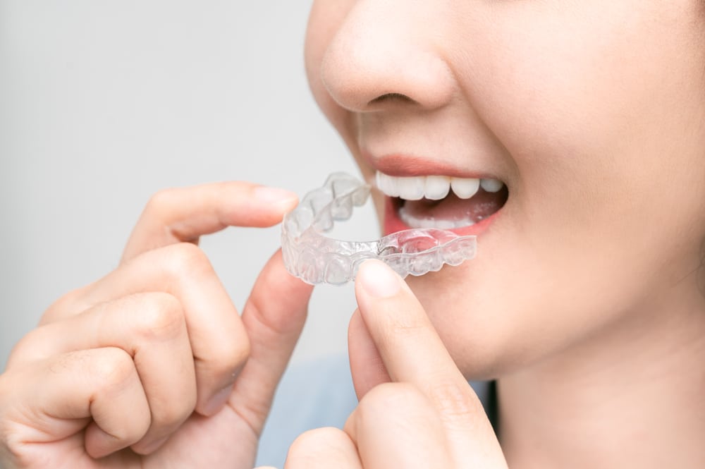 Asian,Woman,Holding,An,Invisalign,Braces,Or,Invisible,Retainer,,Orthodontic
