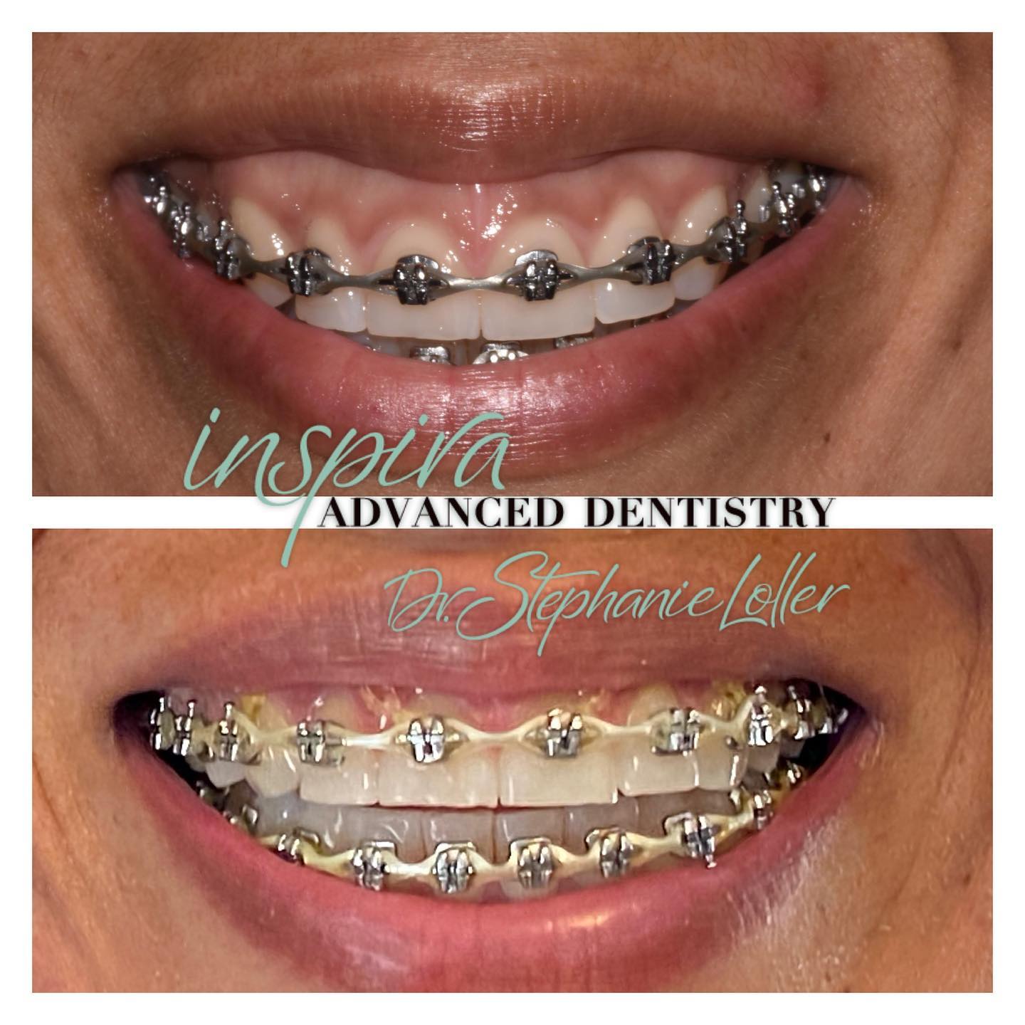 Before and After Image: Smile Makeover - front
