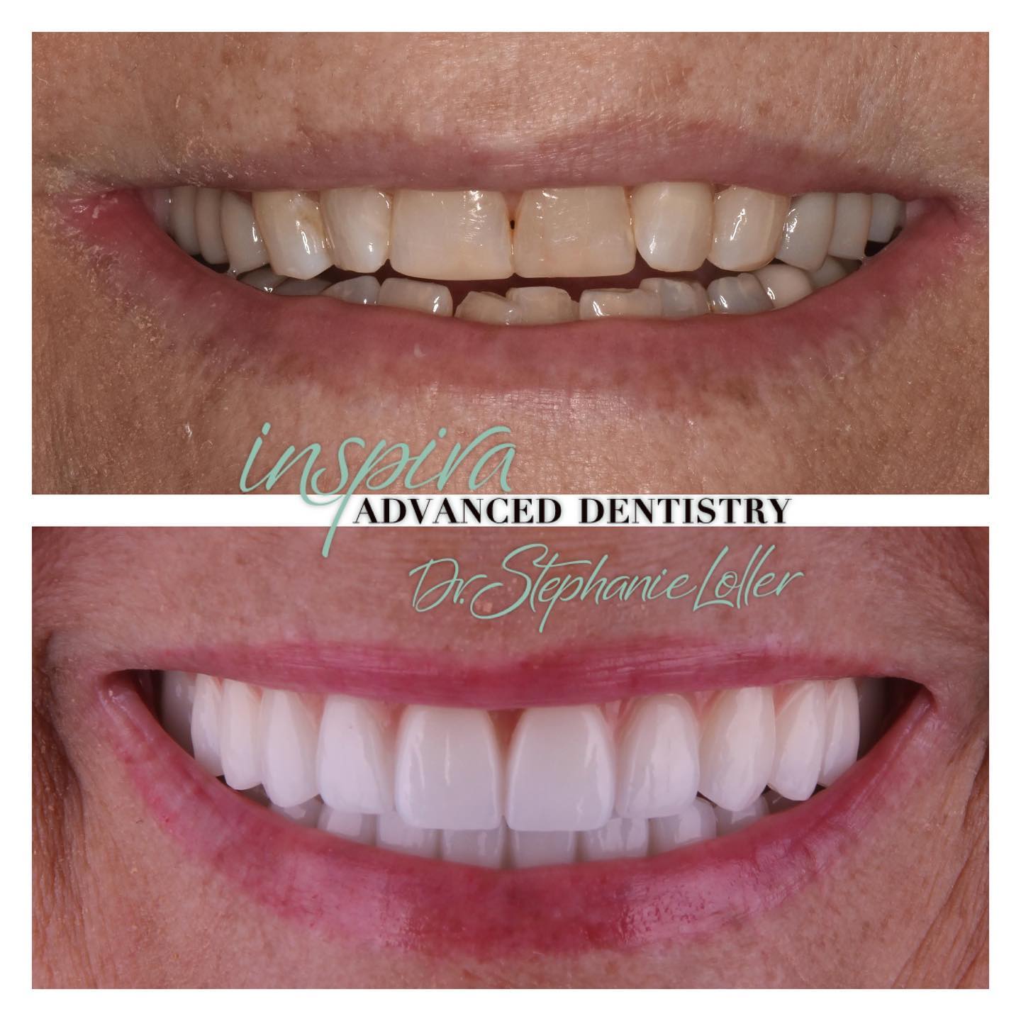 Before and After Image: Smile Makeover - front