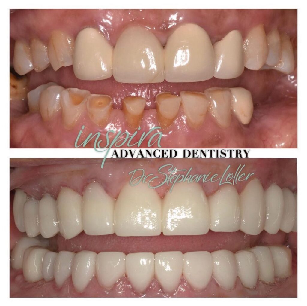 Before and After Image: Smile Makeover - front