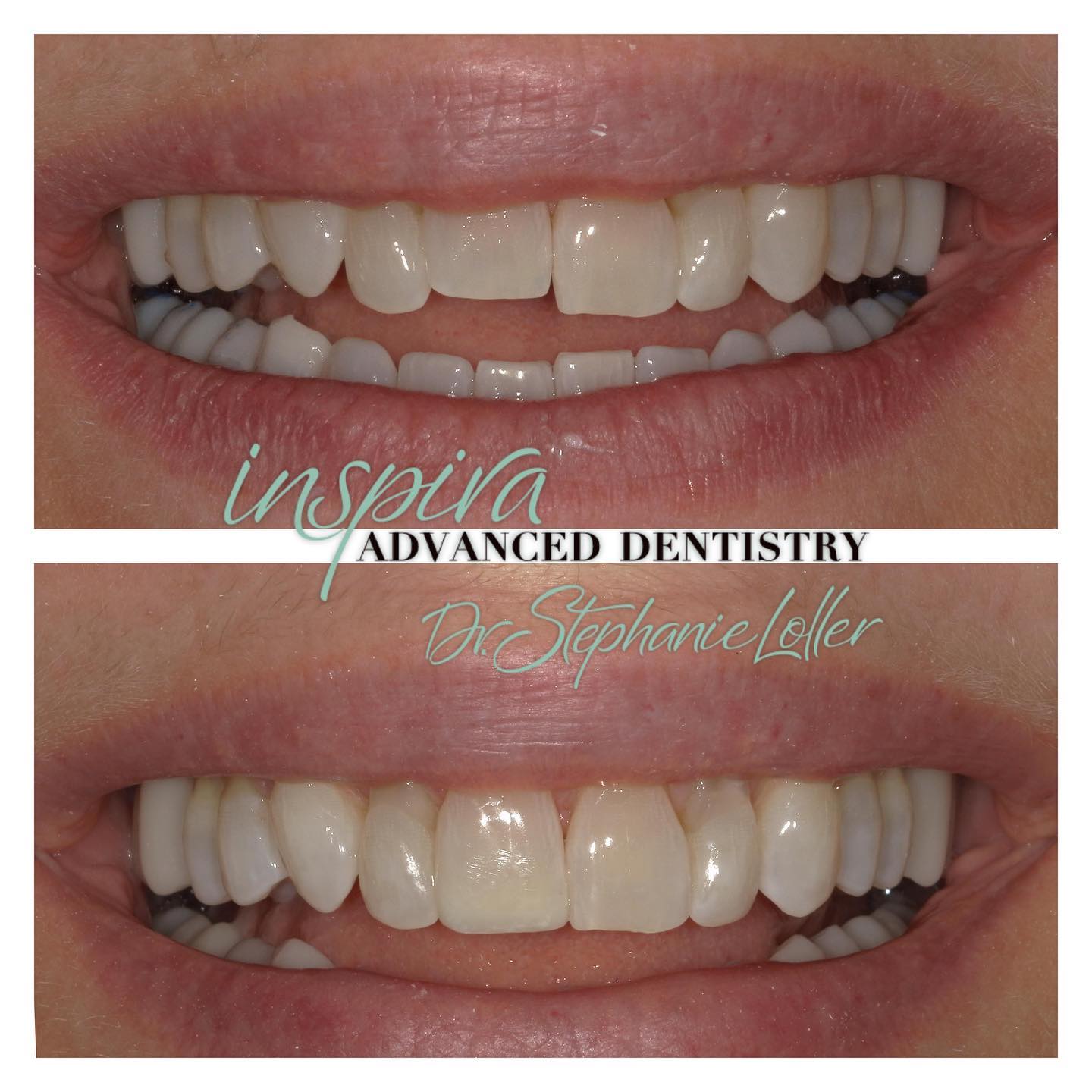 Before and After Image: Smile Makeover - front