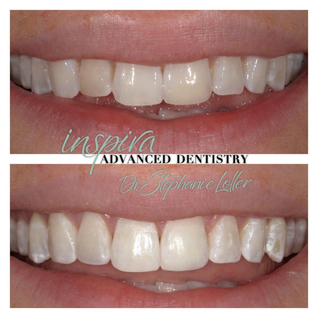 Before and After Image: Smile Makeover - front