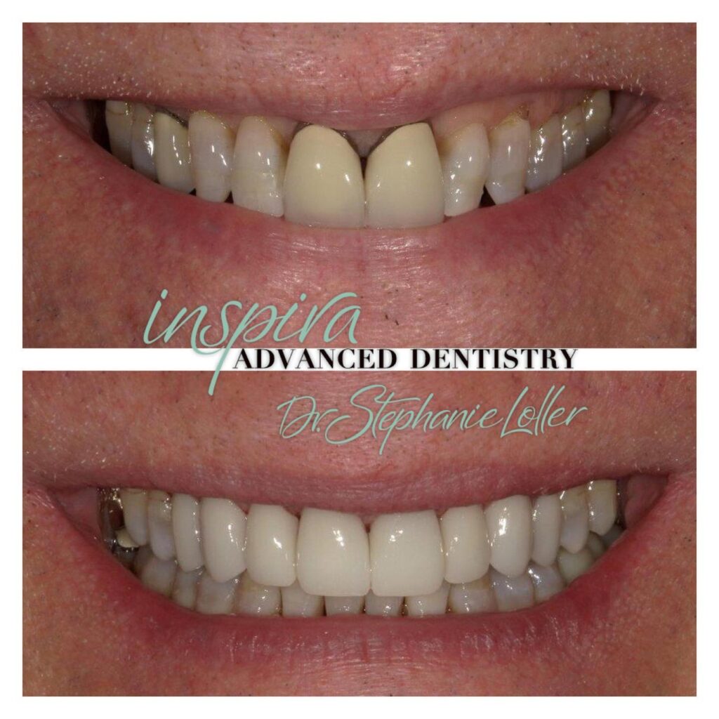 Before and After Image: Smile Makeover - front