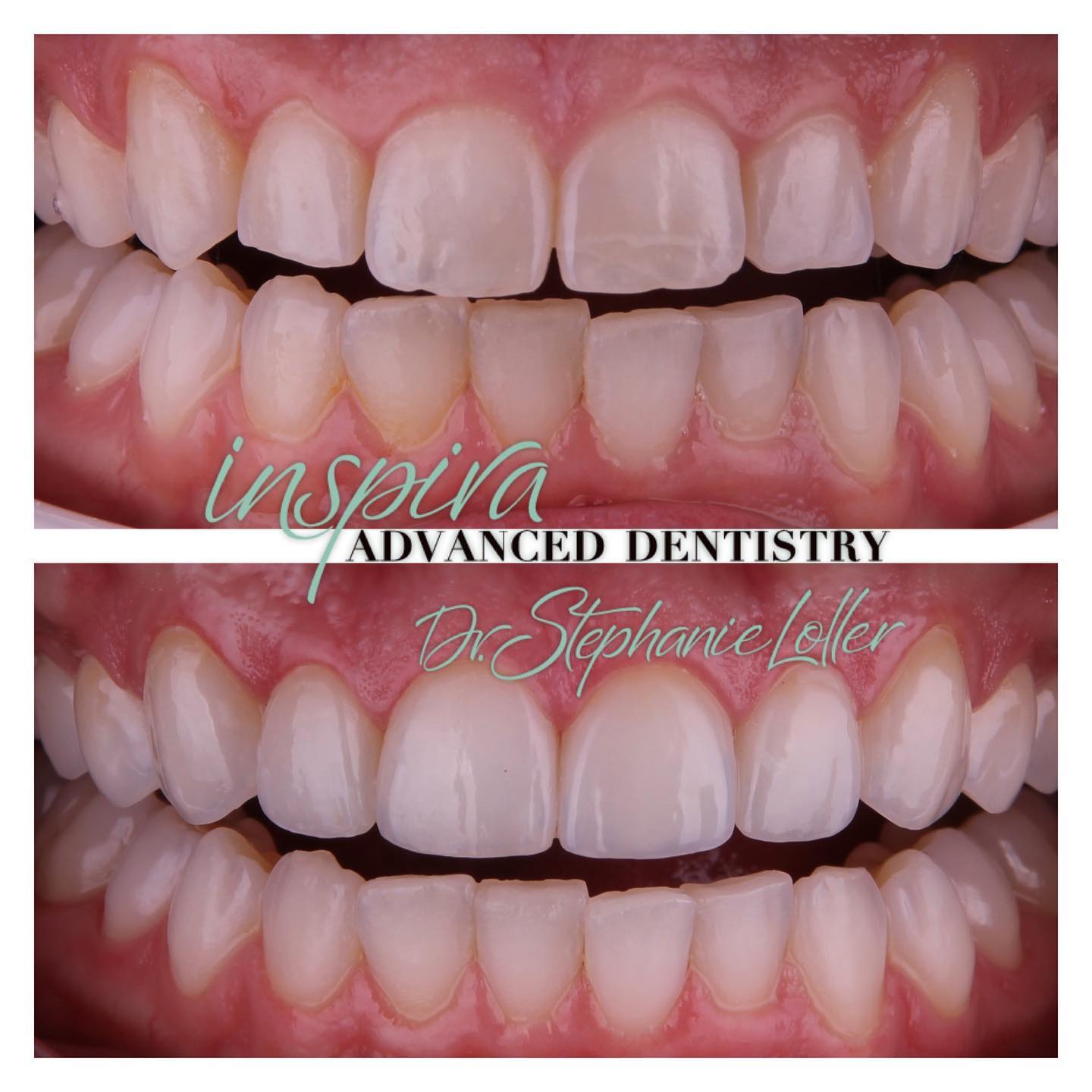 Before and After Image: Smile Makeover - front