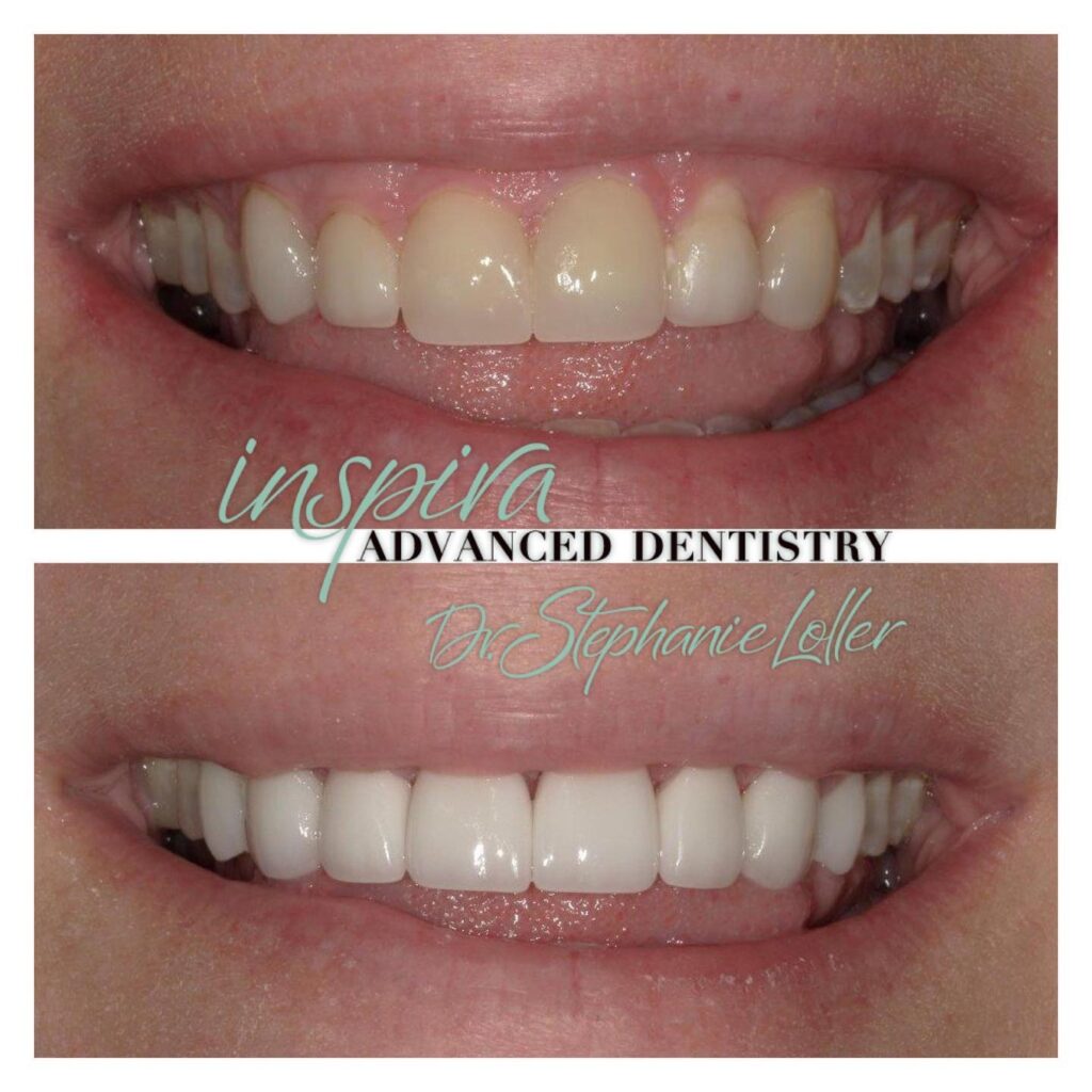 Before and After Image: Smile Makeover - front