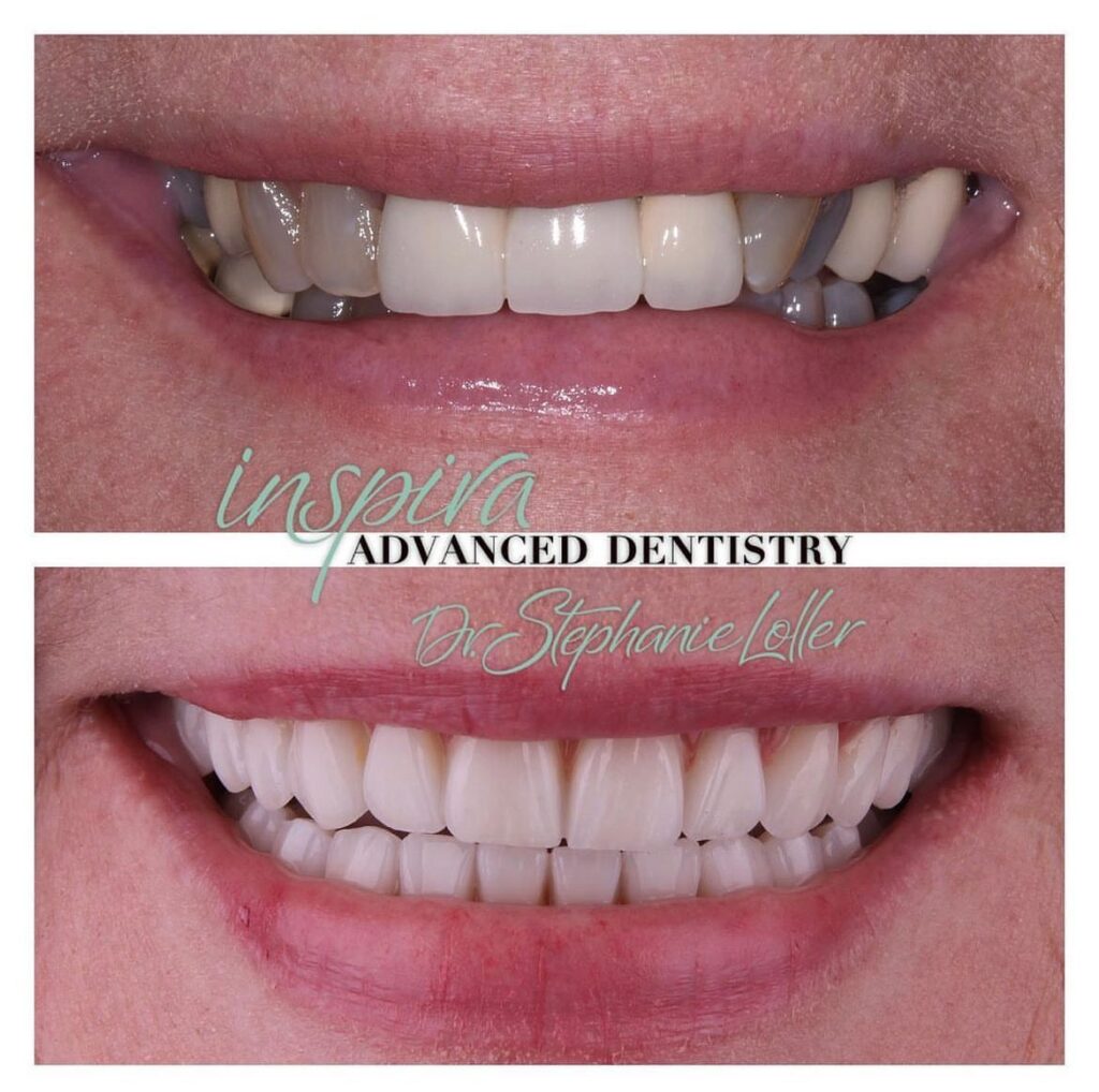 Before and After Image: Smile Makeover - front
