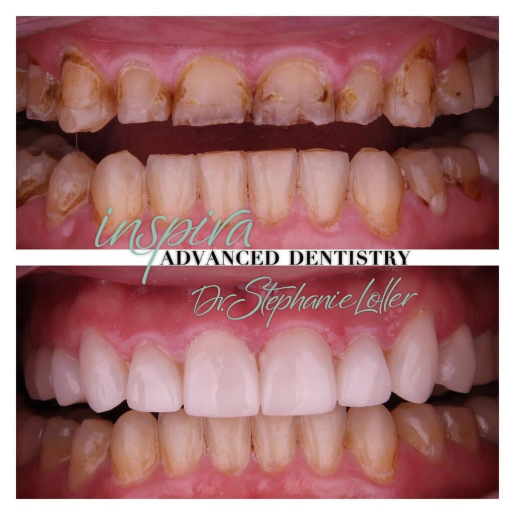 Before and After Image: Smile Makeover - front