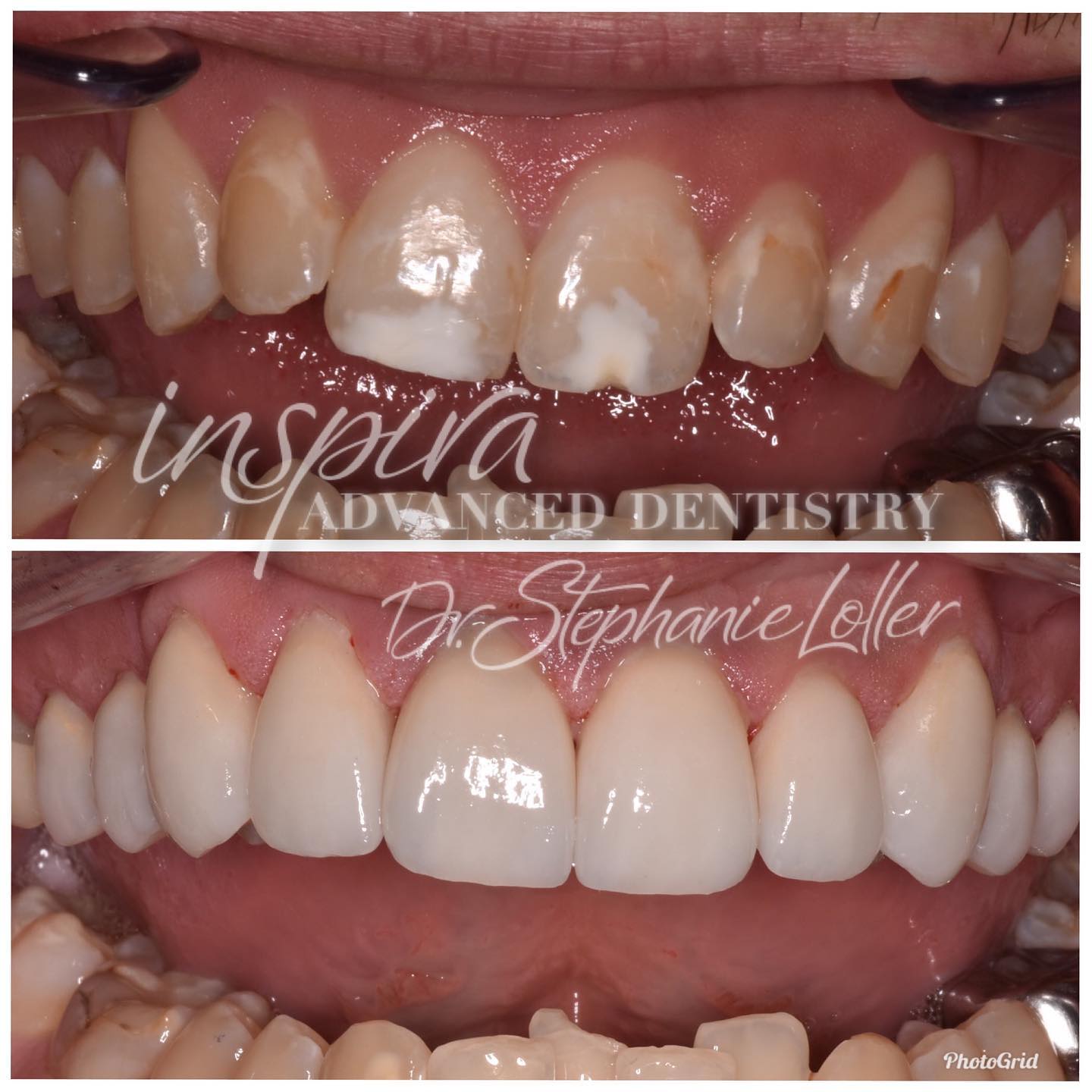 Before and After Image: Smile Makeover - front