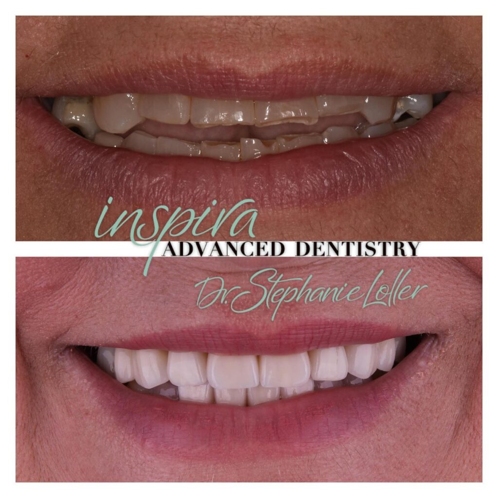 Before and After Image: Smile Makeover - front