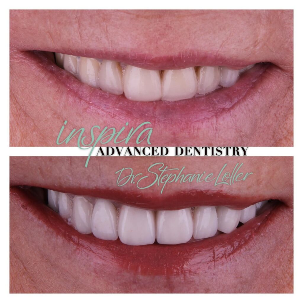 Before and After Image: Smile Makeover - front
