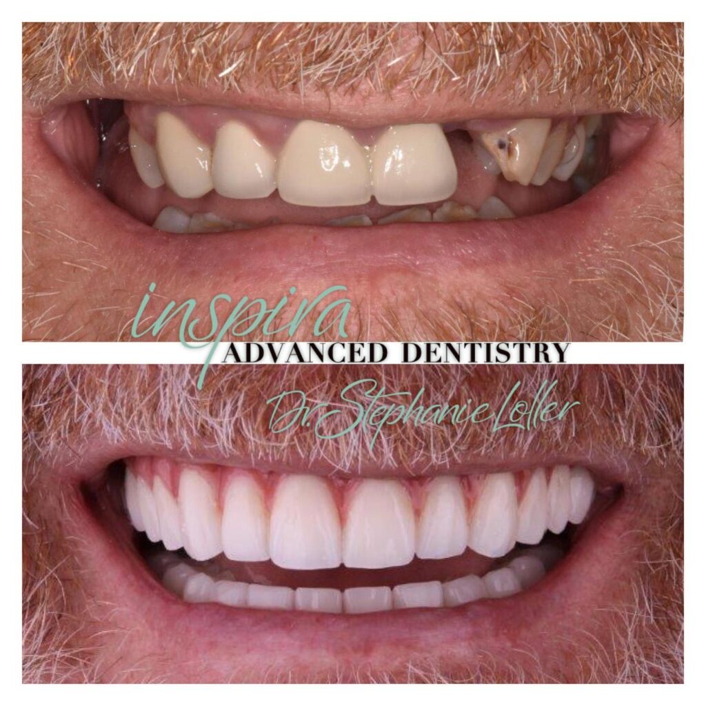 Before and After Image: Smile Makeover - front