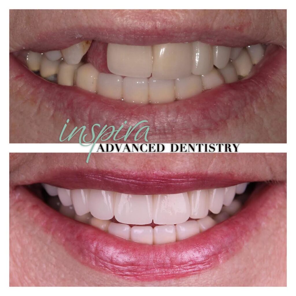 Before and After Image: Smile Makeover - front