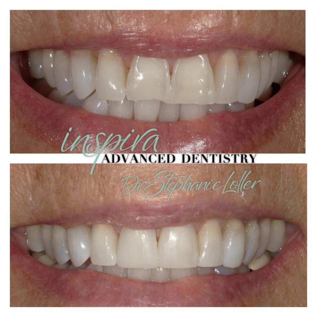 Before and After Image: Smile Makeover - front