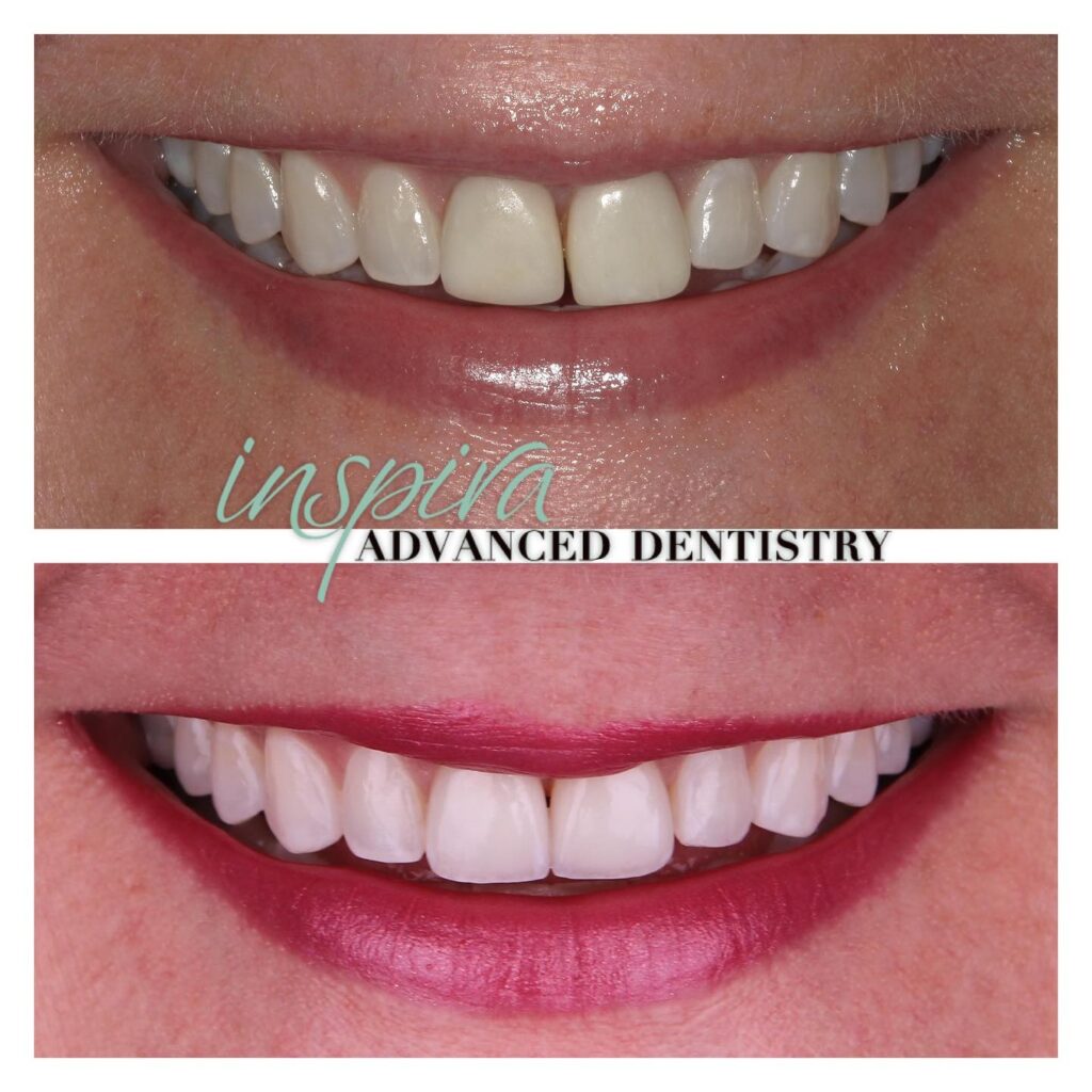 Before and After Image: Smile Makeover - front