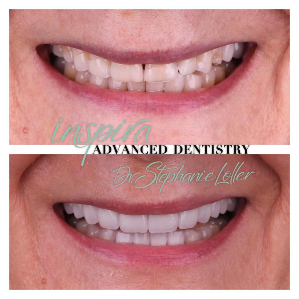 Before and After Image: Smile Makeover - front