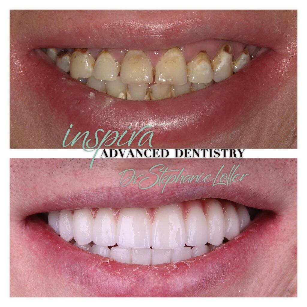 Before and After Image: Smile Makeover - front