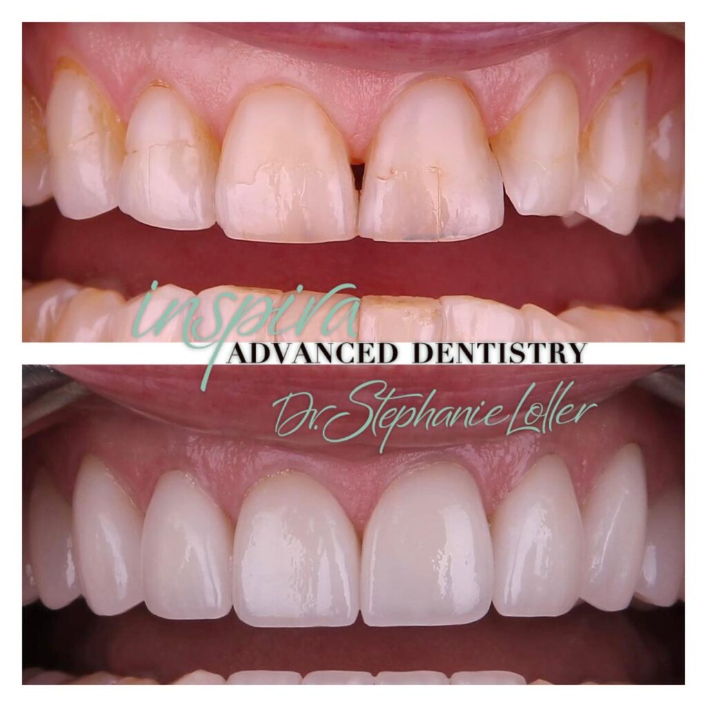 Before and After Image: Smile Makeover - front