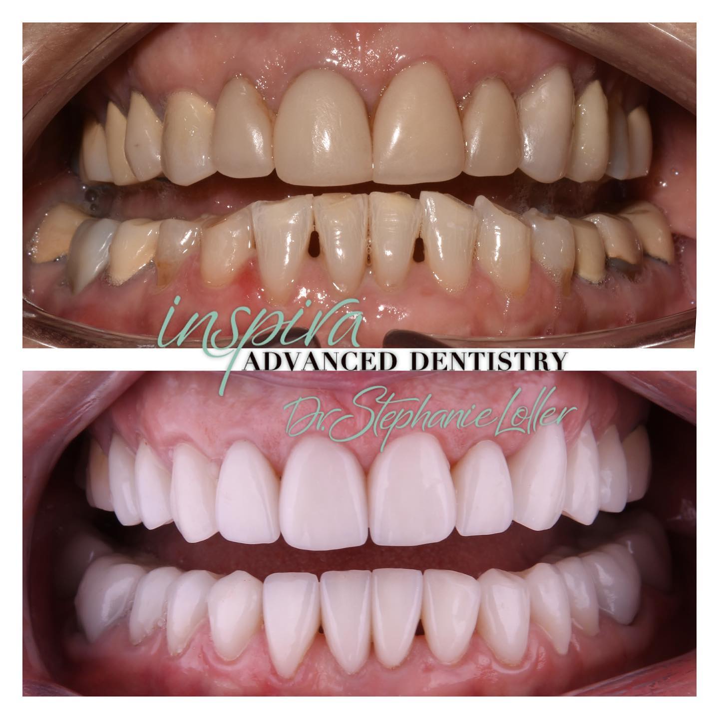 Before and After Image: Smile Makeover - front