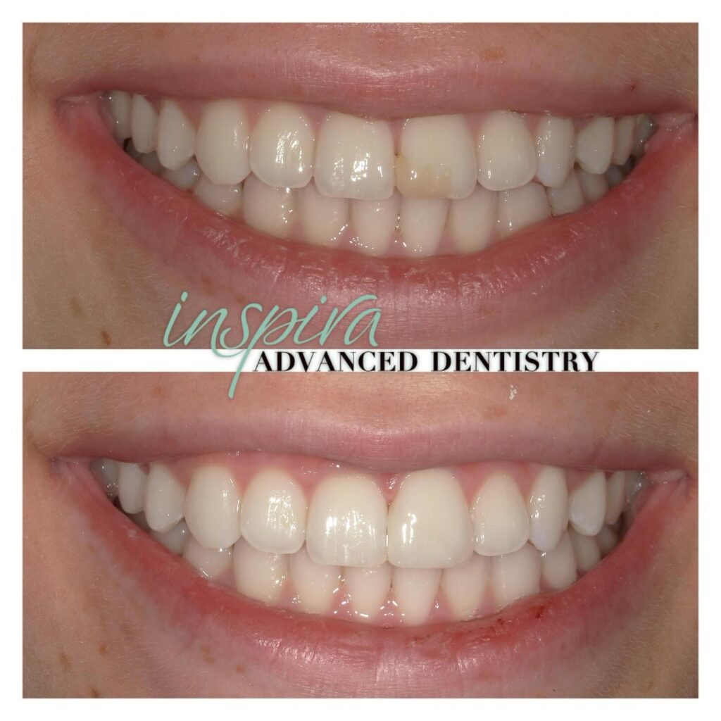 Before and After Image: Smile Makeover - front