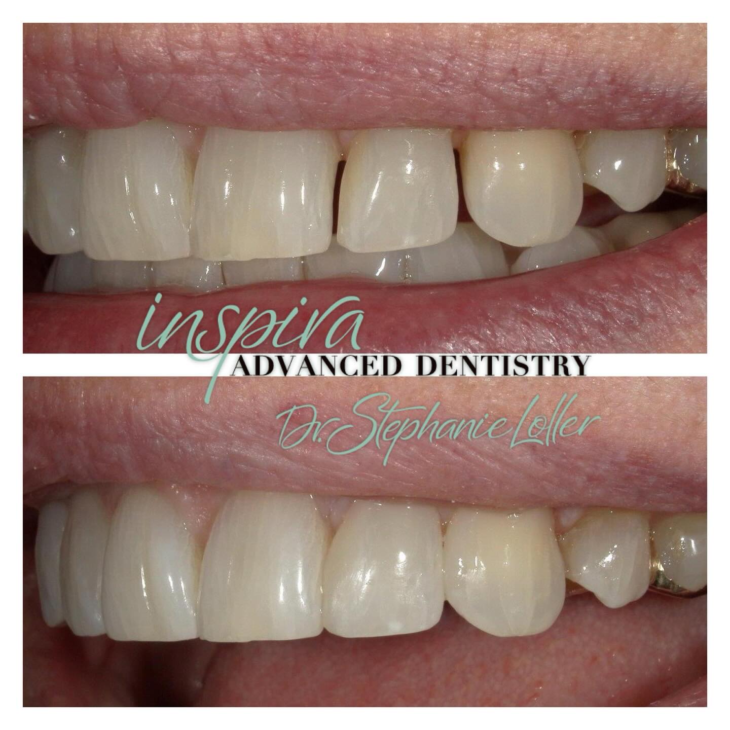 Before and After Image: Smile Makeover - front