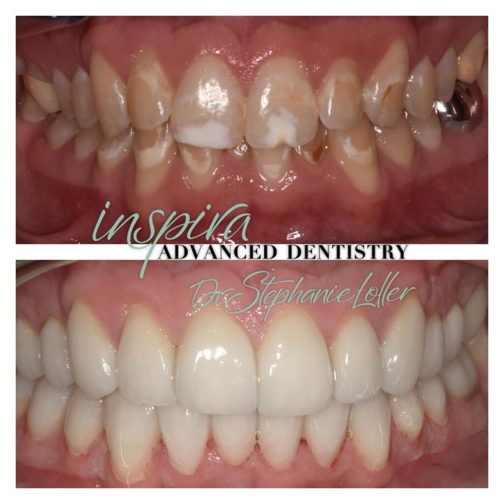 Before and After Image: Smile Makeover - front