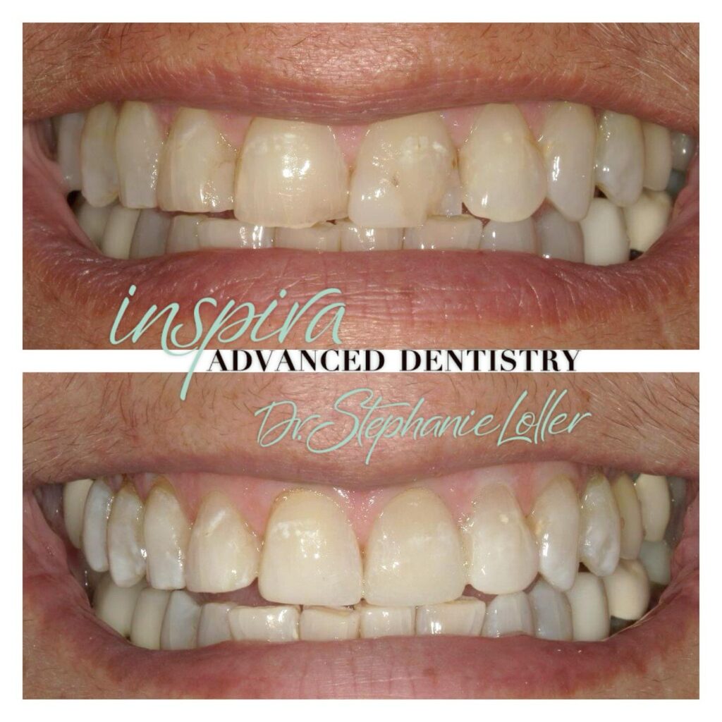 Before and After Image: Smile Makeover - front