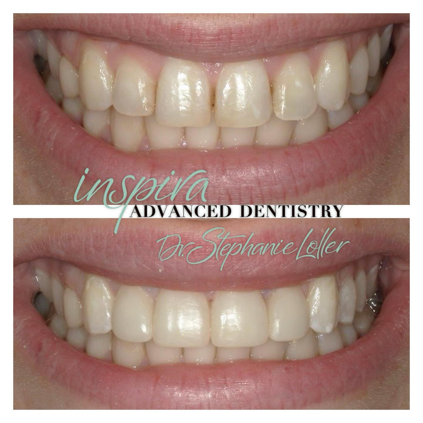 Before and After Image: Smile Makeover - front