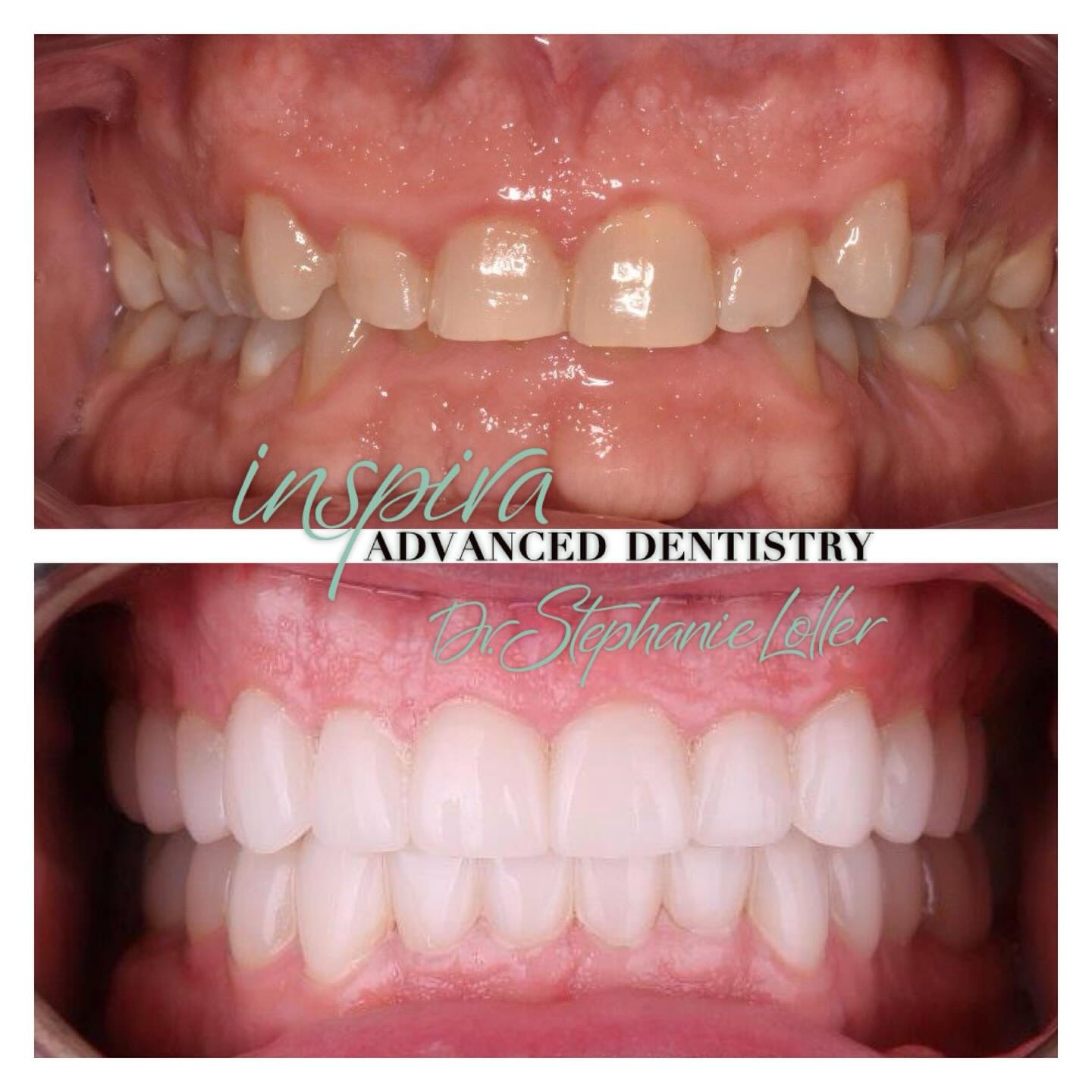 Before and After Image: Smile Makeover - front