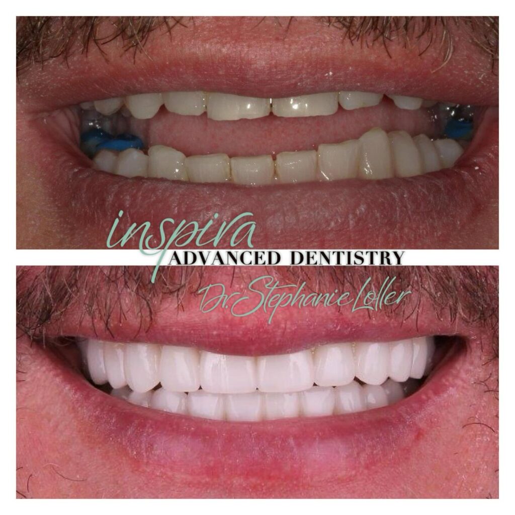 Before and After Image: Smile Makeover - front