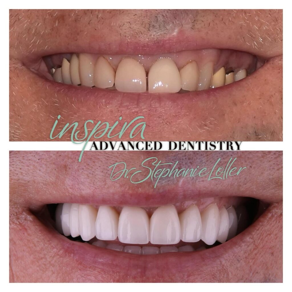 Before and After Image: Smile Makeover - front