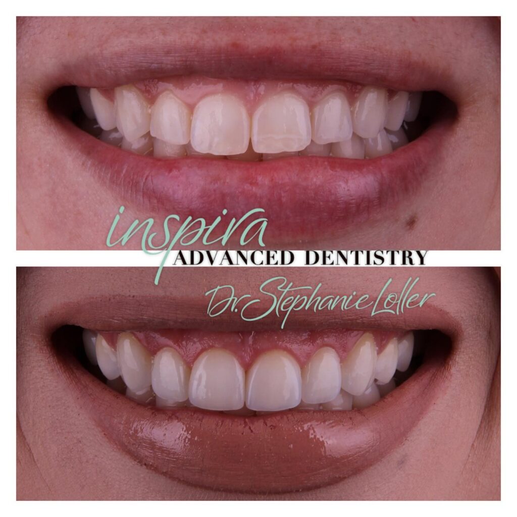 Before and After Image: Smile Makeover - front
