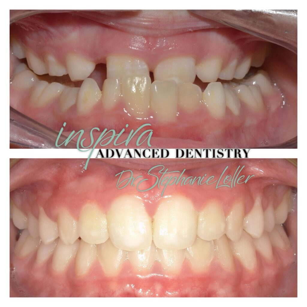 Before and After Image: Smile Makeover - front