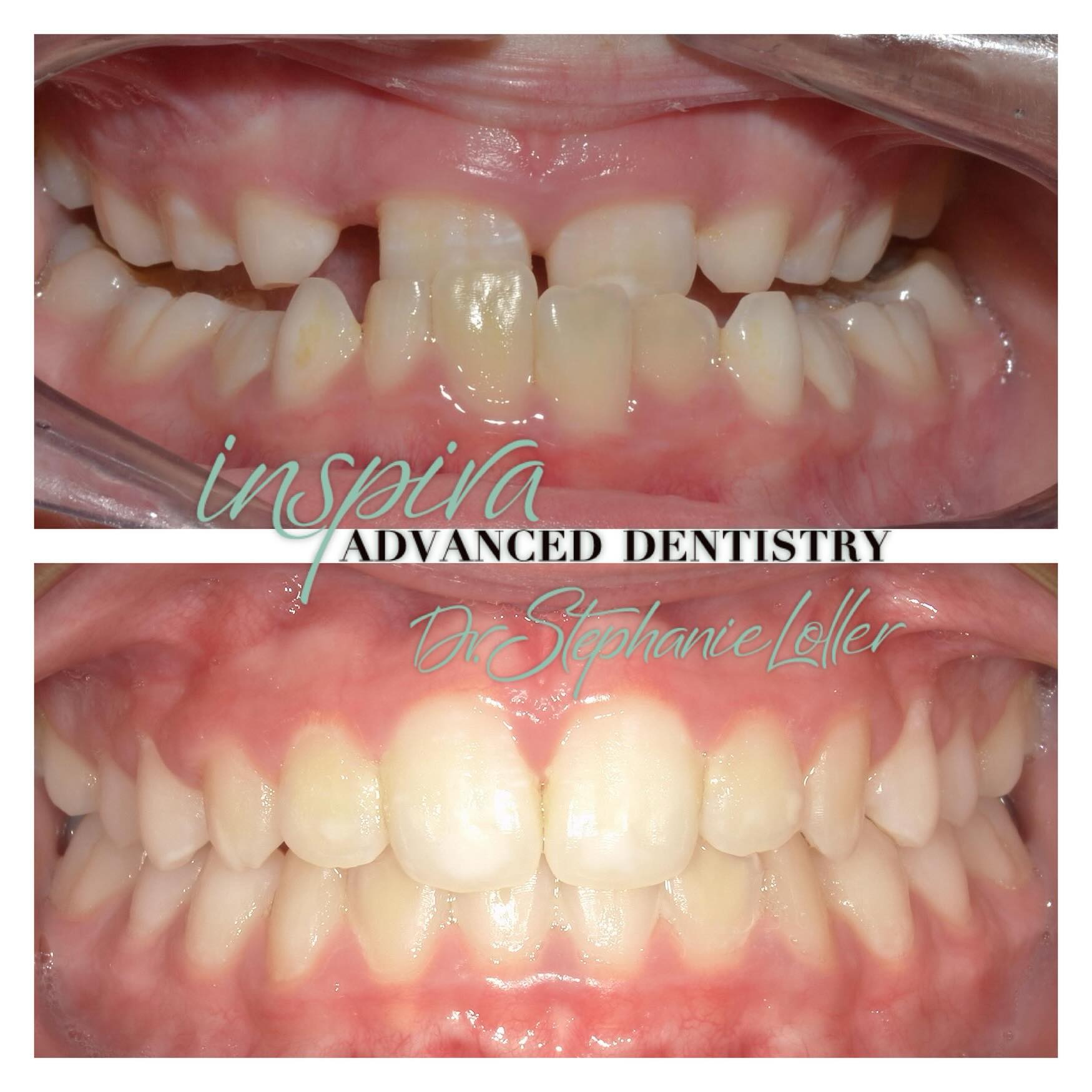 Before and After Image: Smile Makeover - front