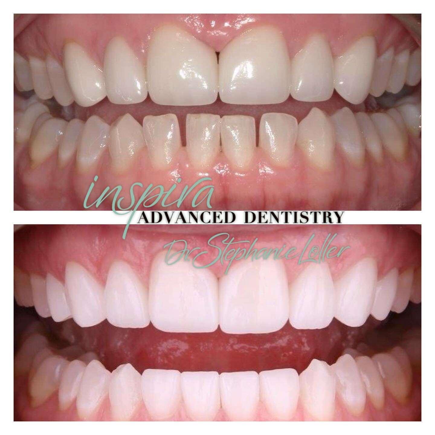 Before and After Image: Smile Makeover - front