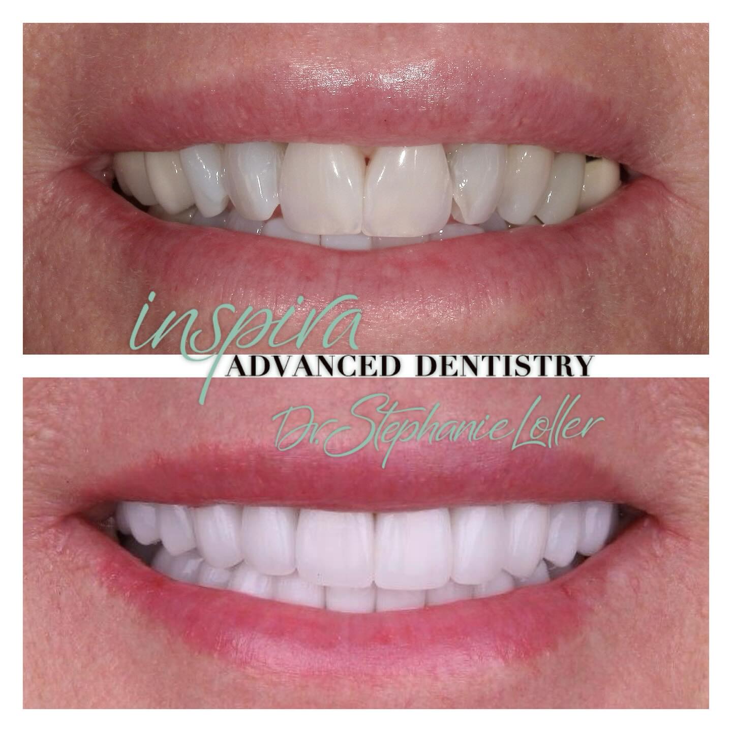 Before and After Image: Smile Makeover - front