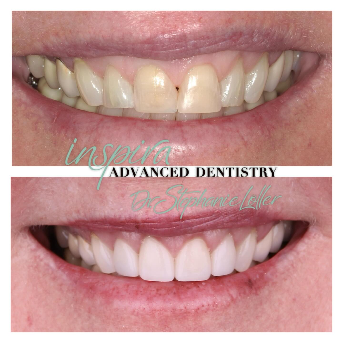 Before and After Image: Smile Makeover - front