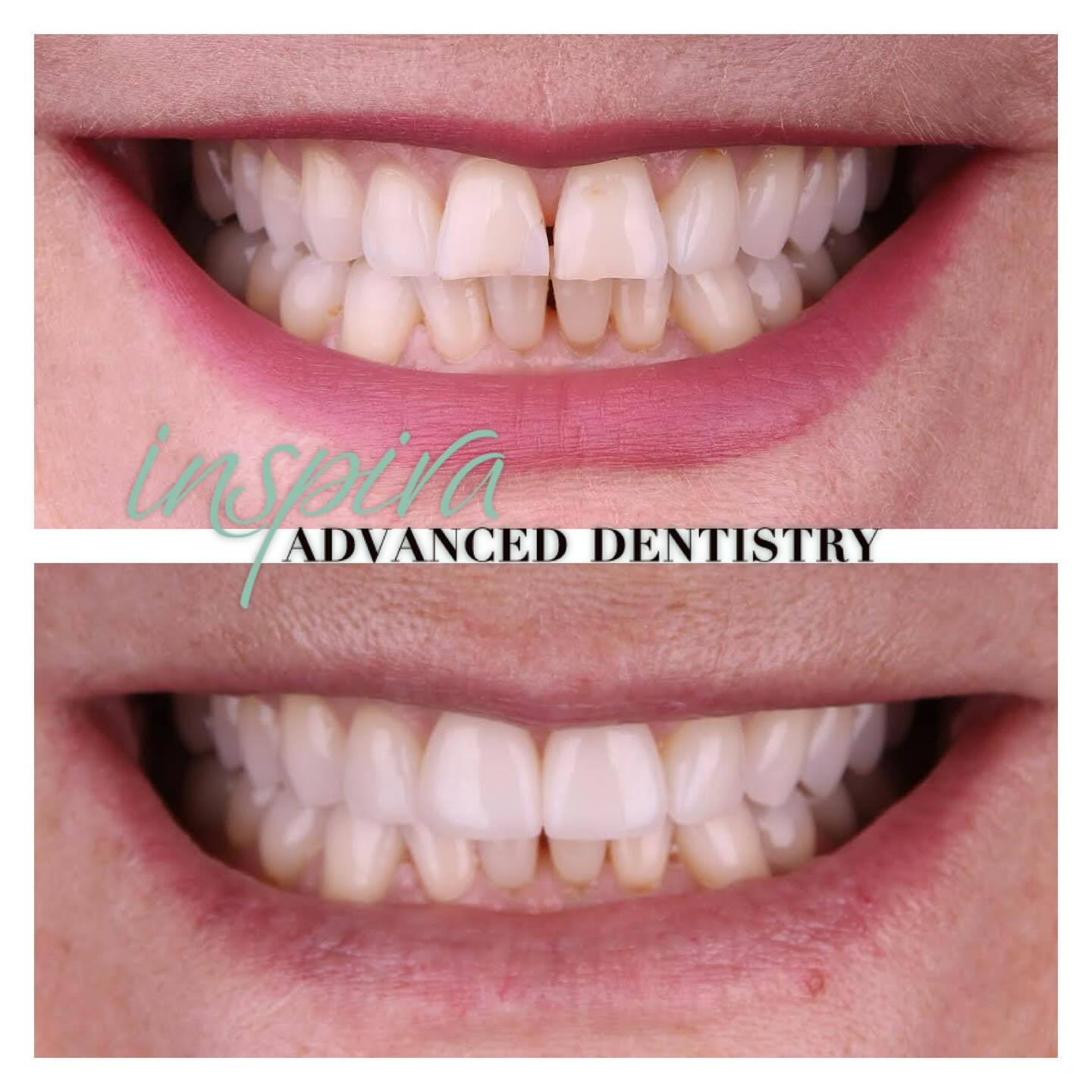 Before and After Image: Smile Makeover - front