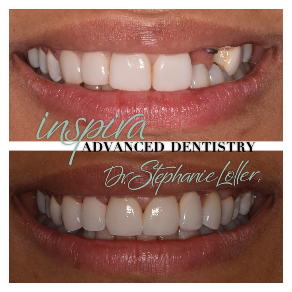 Before and After Image: Smile Makeover - front