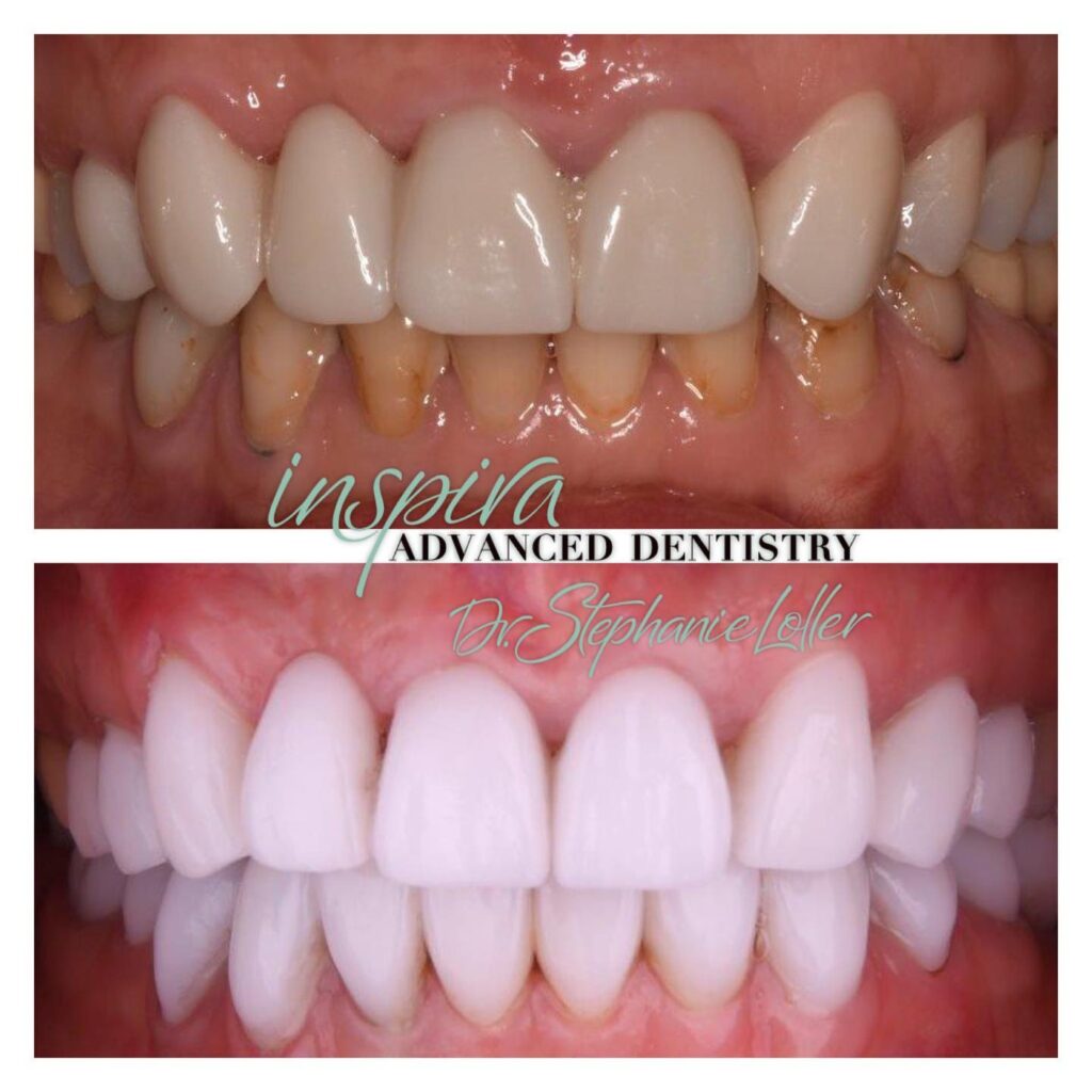 Before and After Image: Smile Makeover - front