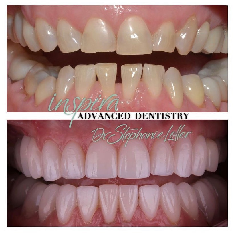 Before and After Image: Smile Makeover - front