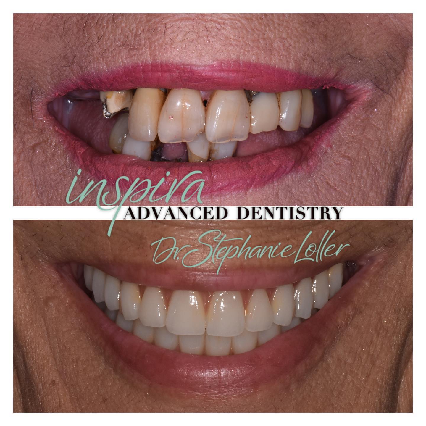 Before and After Image: Smile Makeover - front