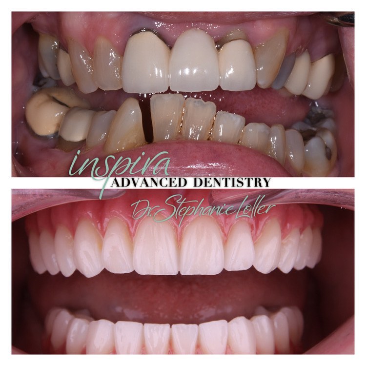 Before and After Image: Smile Makeover - front