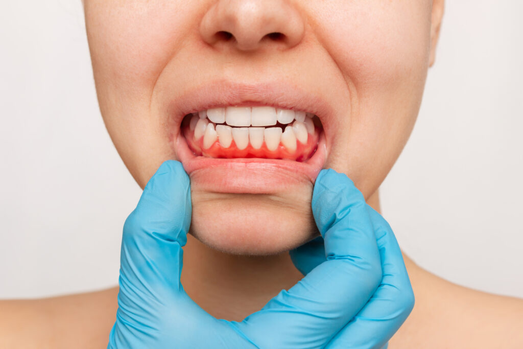 Dentist sees that his patient has inflamed, bleeding gums.